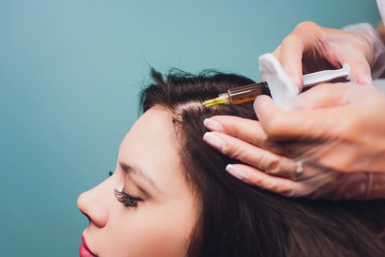 vampire lifting para recuperar el pelo