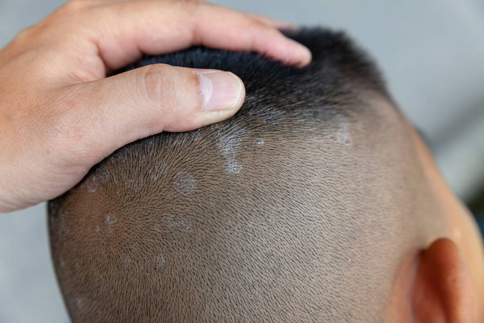 Hombre con dermatitis seborreica en el cuero cabelludo