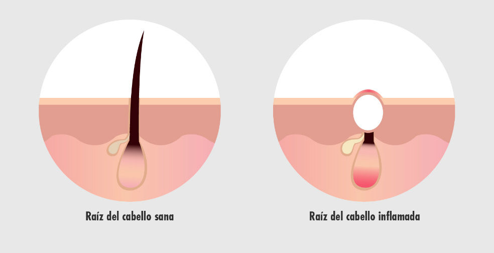 Raíz en estado normal vs. raíz inflamada por foliculitis luego del trasplante capilar