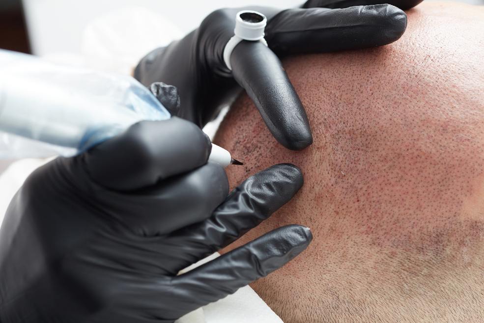 Micropigmentación capilar