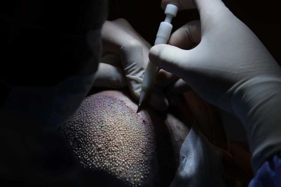 El lápiz Choi se utiliza en los tratamientos capilares DHI