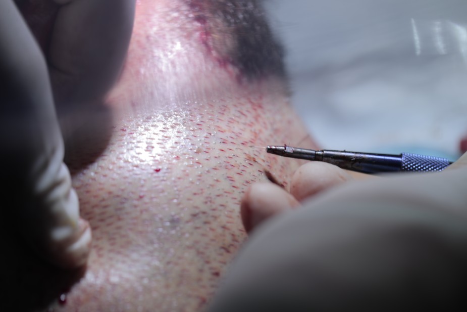 Injerto capilar con zafiro