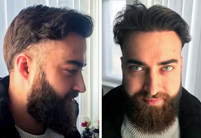 Imagen del resultado 8 meses desde el implante de barba con 4250 grafts Andre U.