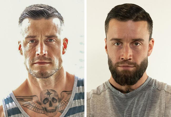 Comparativa antes y después del implante de barba con 4200 injertos de Jhaki