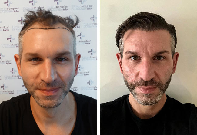 Comparativa del Antes y despues del injerto capilar fue zafiro 4250 grafts Thomas S.