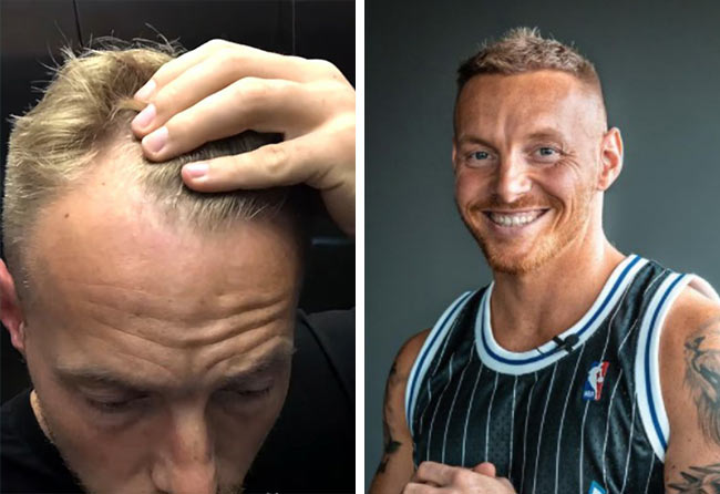 ANtes y después del injerto capilar fue zafiro con 3100 grafts de Coach Stef