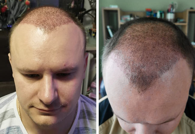 2 meses despues injerto capilar FUE Zafiro 4200-grafts-Sergej-W.