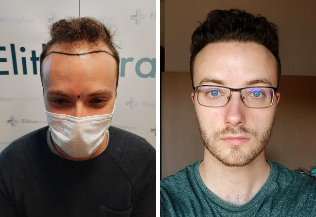 Comparativa antes y después del injerto capilar fue zafiro con 4500 grafts de Didac S.