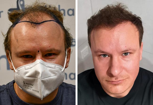 Antes y después injerto capilar FUE Zafiro 4200-grafts-Sergej-W.