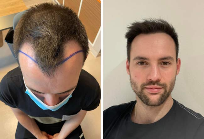 Imagen comparativa del antes y después del trasplante capilar FUE Zafiro de 2700 grafts del paciente Alexander V.