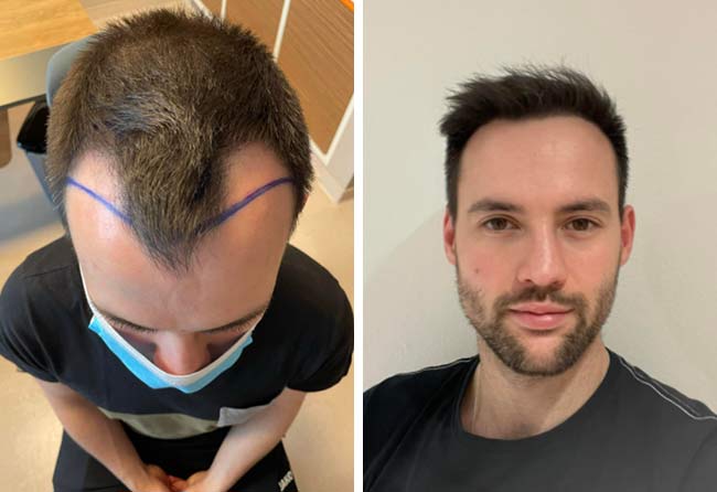 Imagen comparativa del antes y después del trasplante capilar FUE Zafiro de 2700 grafts del paciente Thorsten S.