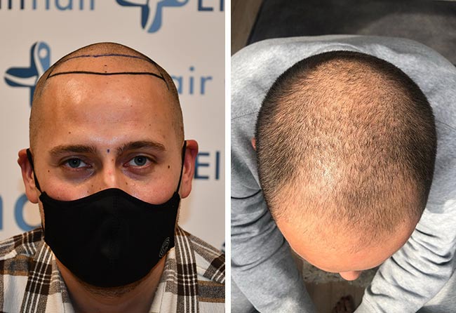 Antes del transplante de cabello neo fue DHI con 4000 injertos del paciente Monier A.