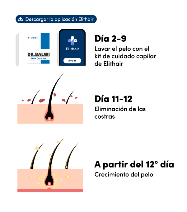 Cuánto dura la recuperación de un trasplante capilar en Elithair.