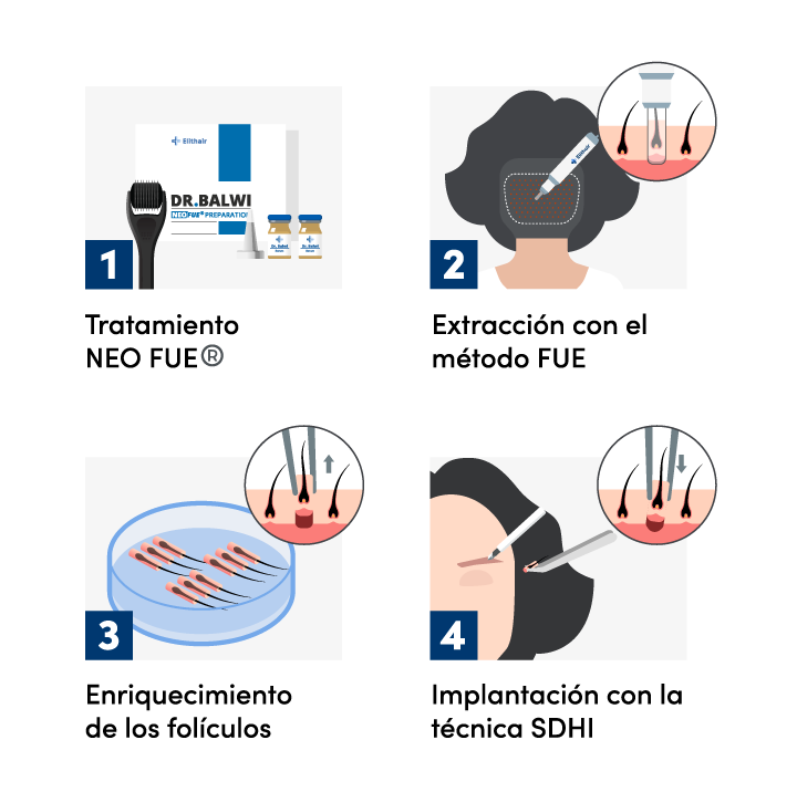 Imagen gráfica del procedimiento de un implante de cejas en Elithair.