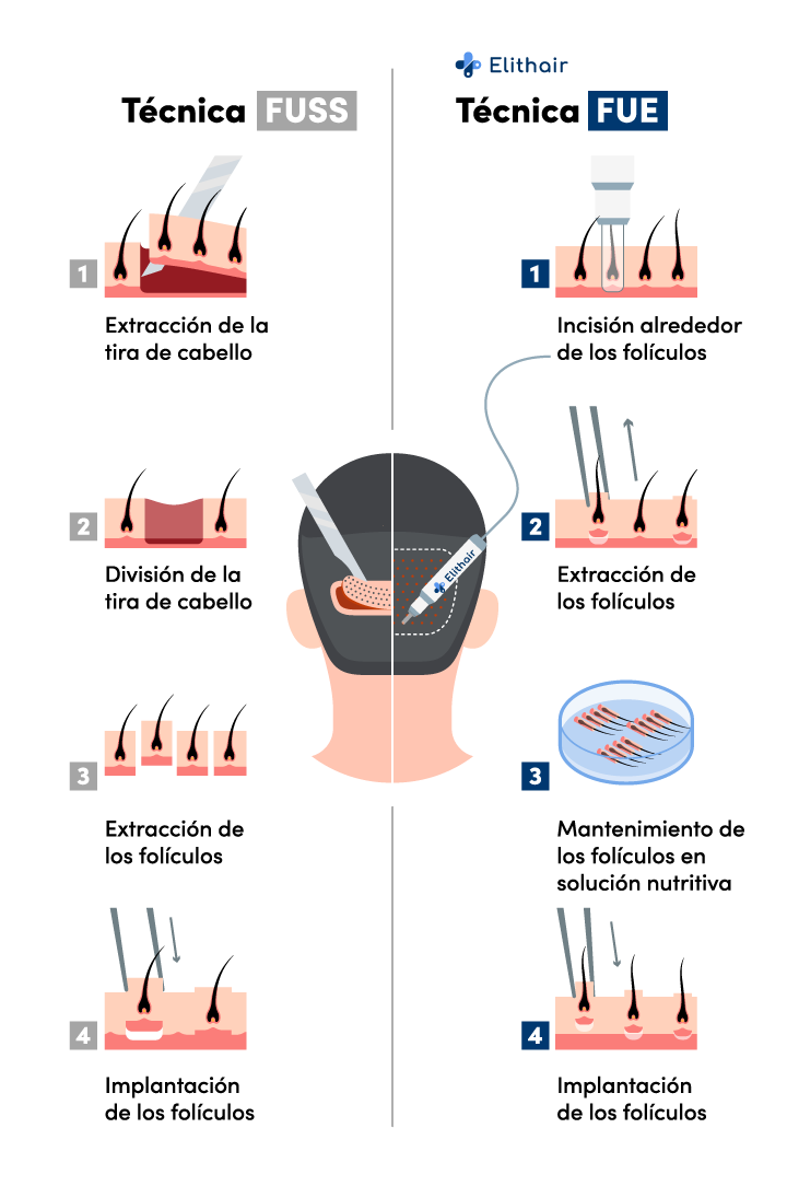 Infográfica con la comparación de las técnicas de injerto capilar FUE y FUT.