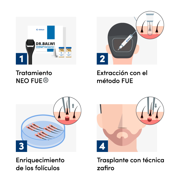 Procedimiento de implante de barba en la clínica Elithair. La imagen muestra a un especialista realizando el trasplante de barba, cuidando la colocación precisa de cada injerto para lograr una apariencia natural y uniforme