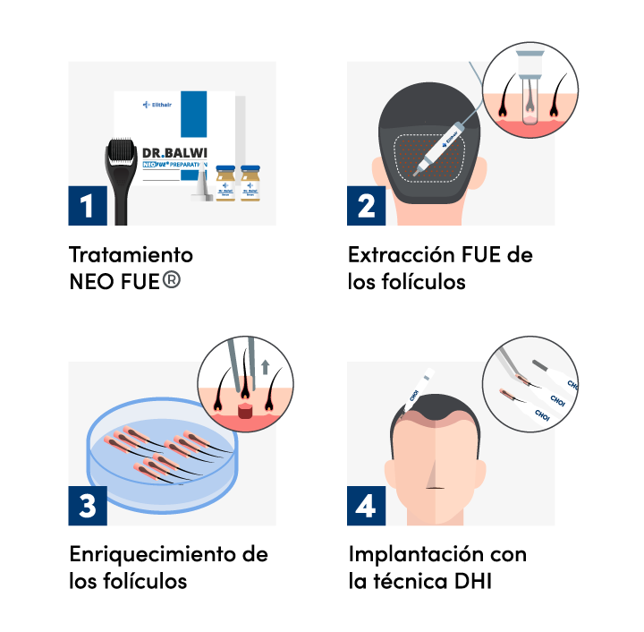 Imagen gráfica del procedimiento de un injerto capilar con la técnica DHI en Elithair.