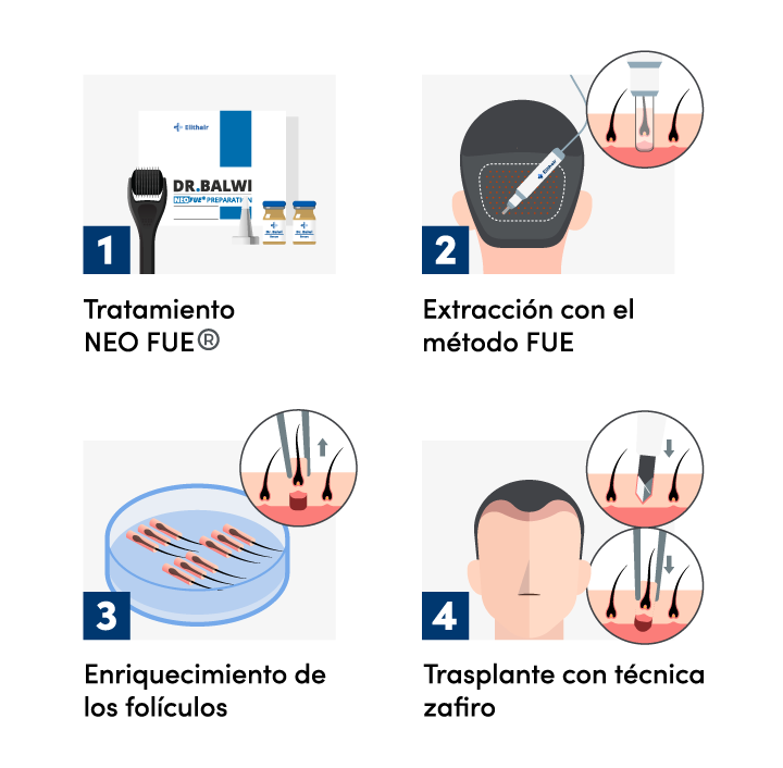 Gráfico con el procedimiento de un injerto capilar FUE Zafiro en Elithair.