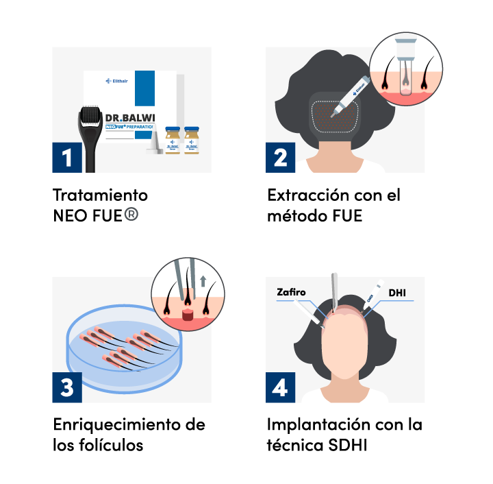 Imagen gráfica del procedimiento de un injerto capilar para mujer en Elithair.