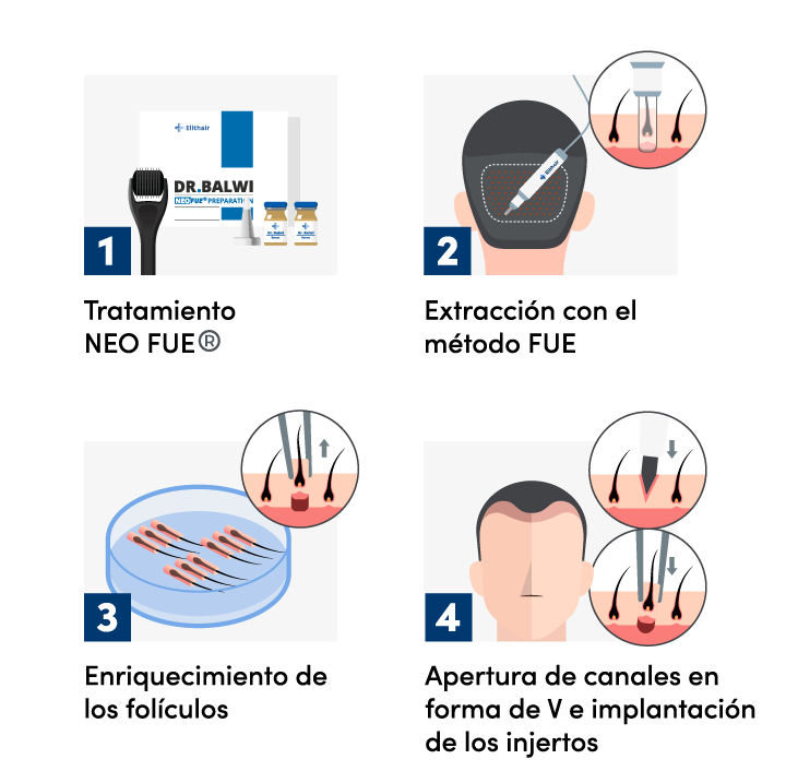 Infográfica del procedimiento de un injerto capilar con la técnica percutánea.