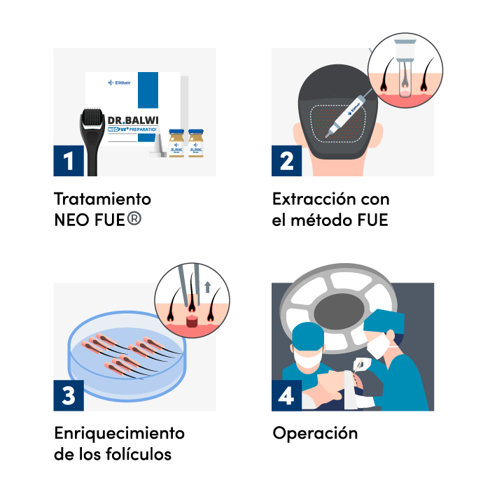 Infográfica de la extracción de los folículos con la técnica FUE.