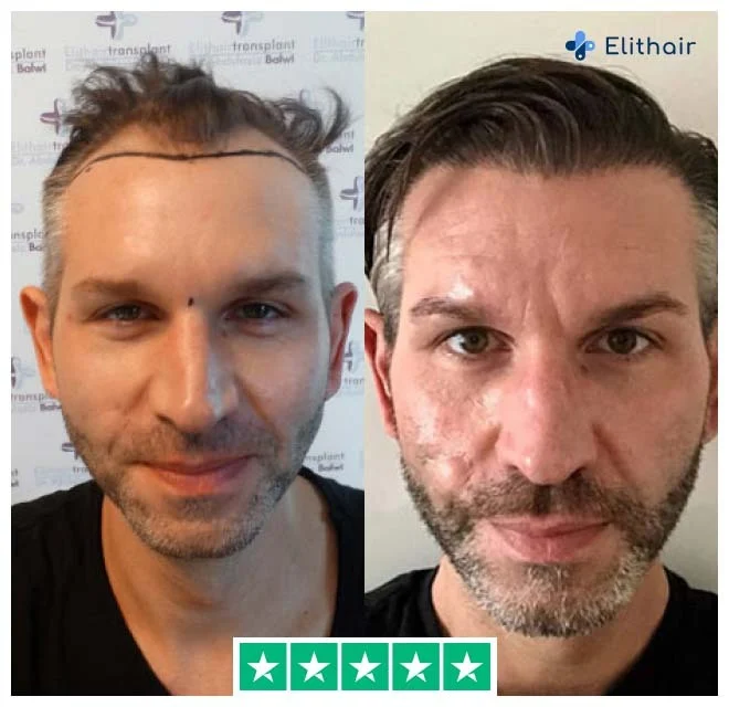 La foto muestra a Thomas, un paciente de Elithair, antes y después de su trasplante capilar de 4250 injertos.