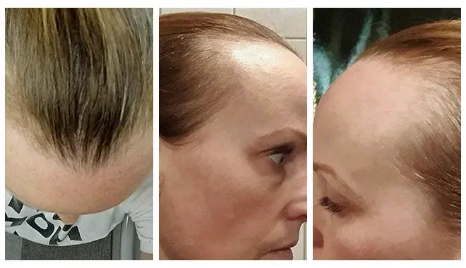 Diagnóstico de pérdida de cabello en mujeres realizado en la clínica Elithair. La imagen muestra a una especialista evaluando el estado del cabello para determinar el tratamiento adecuado.