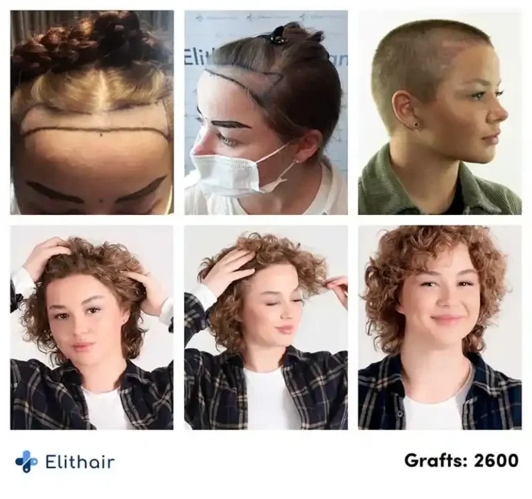 Evolución del trasplante capilar de Liliana en Elithair, con 2600 injertos. La imagen muestra el progreso del crecimiento del cabello desde el trasplante inicial hasta los resultados finales.