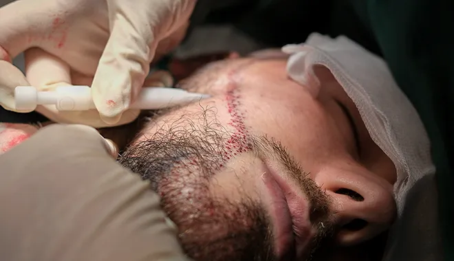 Paciente recibiendo un implante de barba durante la operación en la clínica Elithair. La imagen muestra el proceso en el que los especialistas implantan los injertos de barba cuidadosamente para lograr un resultado natural